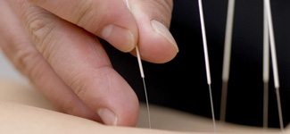 acupuncture